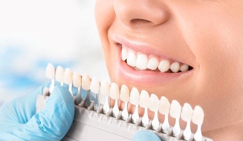 blanqueamiento dental en malaga