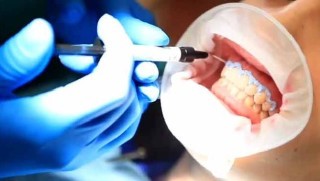 blanqueamiento dental en casa