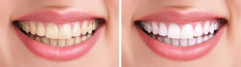 blanqueamiento dental malaga
