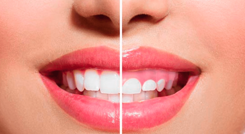 sonrisa gingival